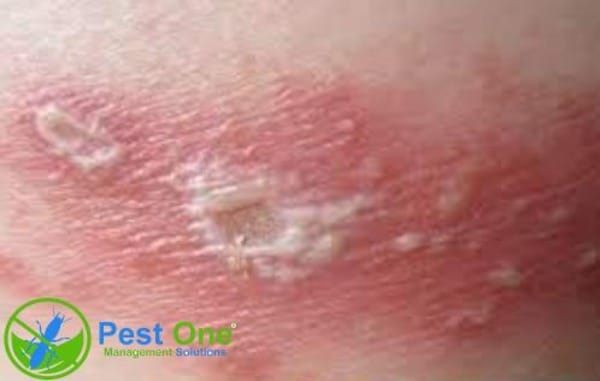 Khi bị kiến ba khoang cắn có bị lây lan không?