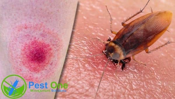 Bị gián cắn có thể bị sưng tấy