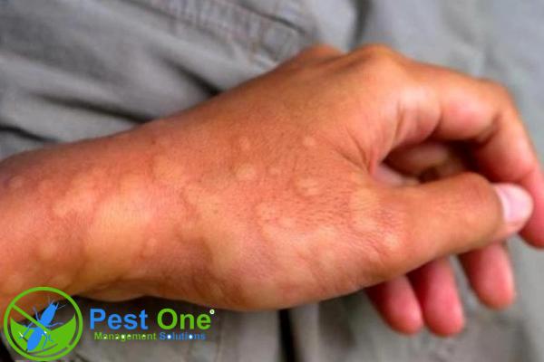 Bị muỗi đốt nhiều có sao không? Bị muỗi đốt nhiều có thể gặp các bệnh nguy hiểm