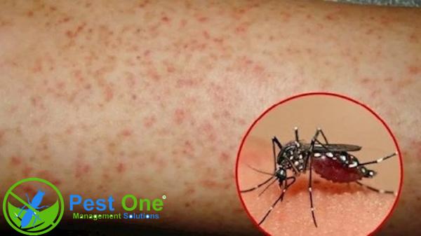 Sốt xuất huyết là một trong những biến chứng thường thấy khi bị muỗi đốt