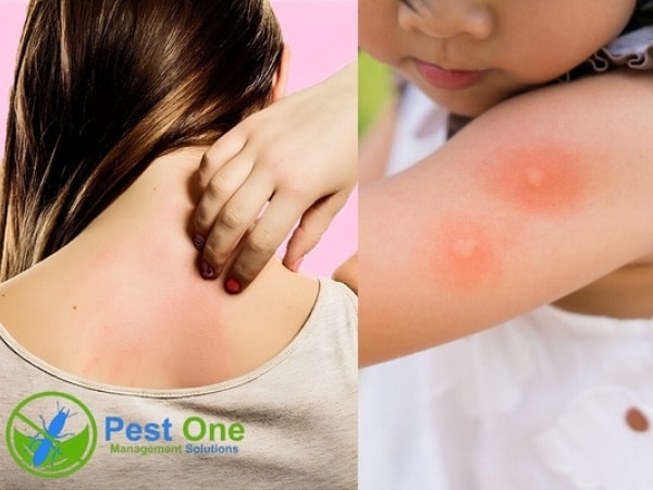 Dấu hiệu từ cơ thể (cắn, đốt, dị ứng)